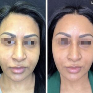 Morpheus8 before and after image