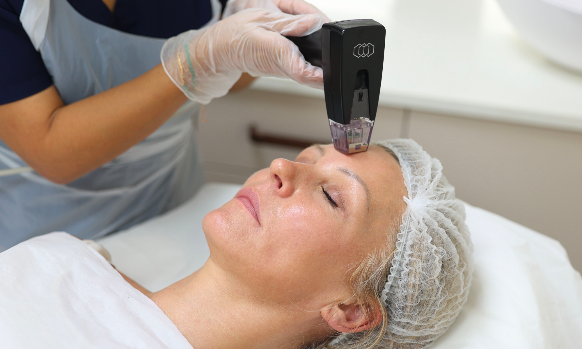 morpheus 8 treatment on a forehead