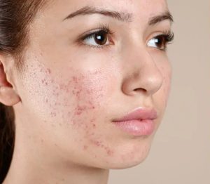 acne and acne scarring on a face