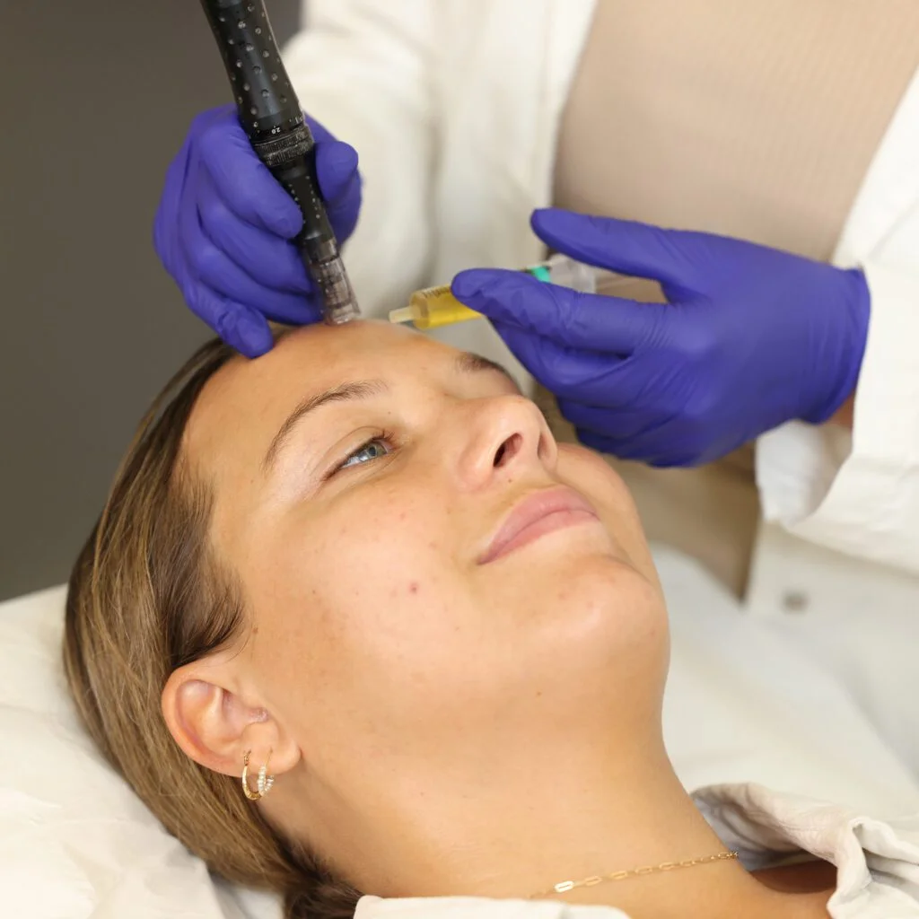 microneedling treatment close up