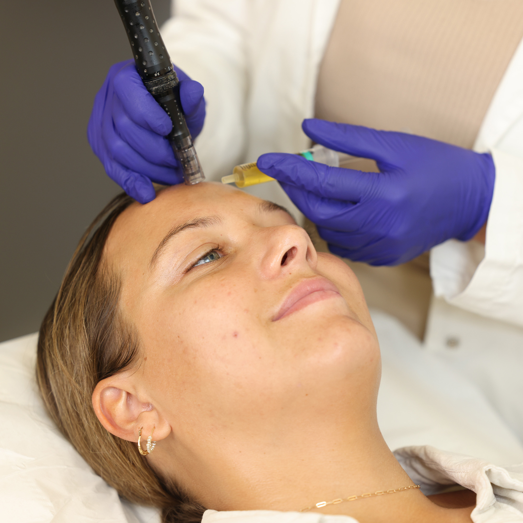 microneedling treatment close up