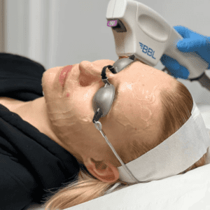 BBL laser Moxi Laser treatment London. Close up of BBL treatment at Omniya during the process. bbl laser london, moxi laser, bbl laser, bbl and moxi, bbl moxi, bbl moxi london, bbl moxi laser, bbl hero london, bbl hero, bbl and moxi laser, bbl treatment, bbl facial, bbl facial London, moxi laser near me, bbl & moxi